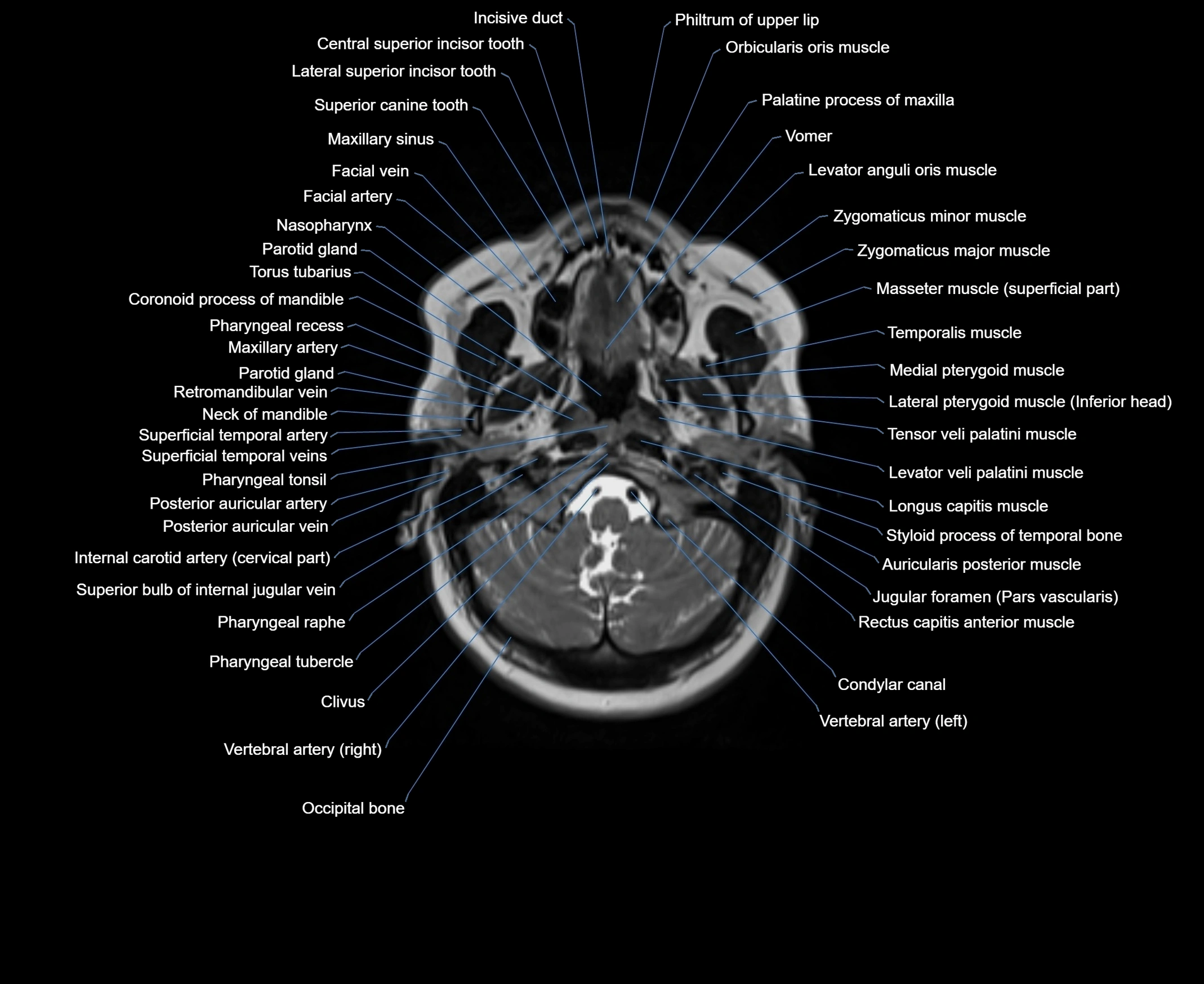 MRI Neck 3D labelled cross section anatomy axial 3t image-00001-00018.webp
